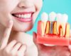 Inilah Proses Pemasangan Implan Gigi dan Risikonya yang Perlu Diketahui