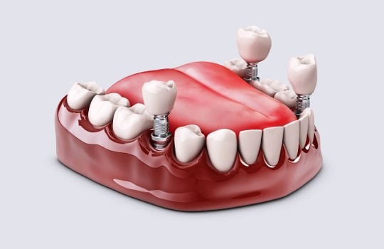 Proses Pemasangan Implan Gigi
